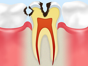 C2： 象牙質の虫歯