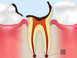 C4：歯の根まで達した虫歯