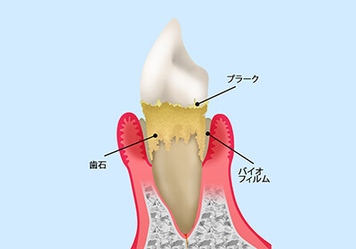 歯周病は歯が抜け落ちてしまう病気です～歯周病治療～