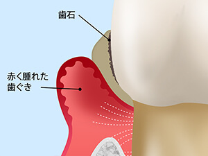 中期歯周病