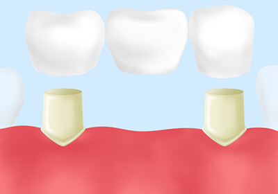歯のない部分に人工歯の橋をかける～ブリッジ～