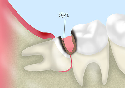 親知らずの抜歯