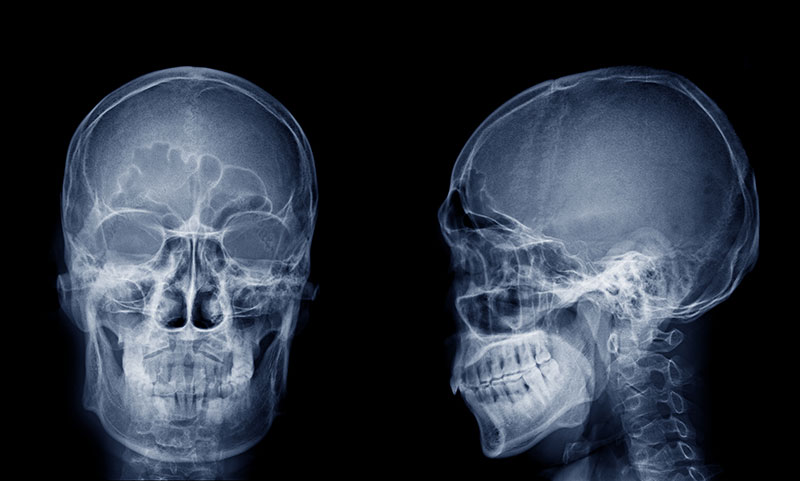 頭部X線規格写真(セファログラム)